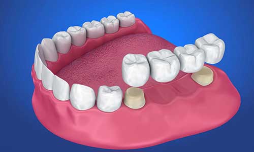 Crown & Bridge | Lumina Dental Clinic 