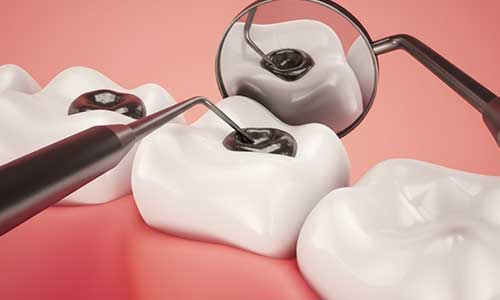 Dental Restoration (Fillings) | Lumina Dental Clinic 