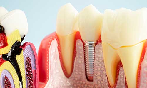 Dental Implants | Lumina Dental Clinic 