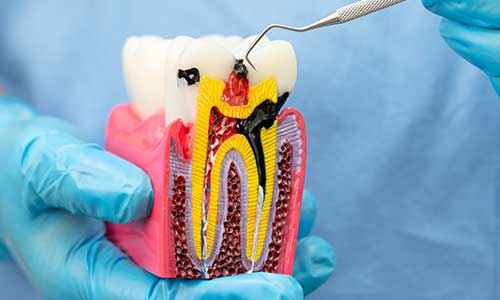 Root Canal Treatment | Lumina Dental Clinic 